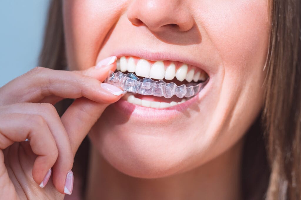 Con apparecchio trasparente si parla male? Tutto quello che devi sapere nella vita quotidiana