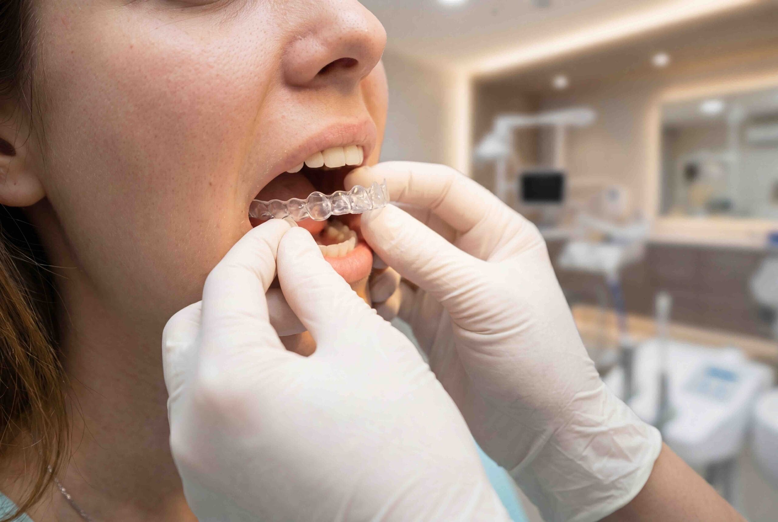 Attachment dentali